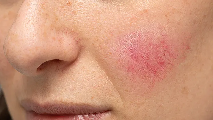 Frau mit Rötungen / Rosacea auf den Wangen