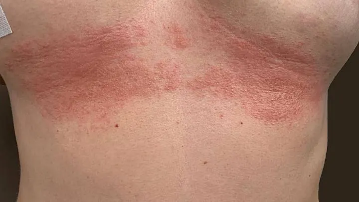 Intertrigo Hautausschlag unter der Brust einer Frau