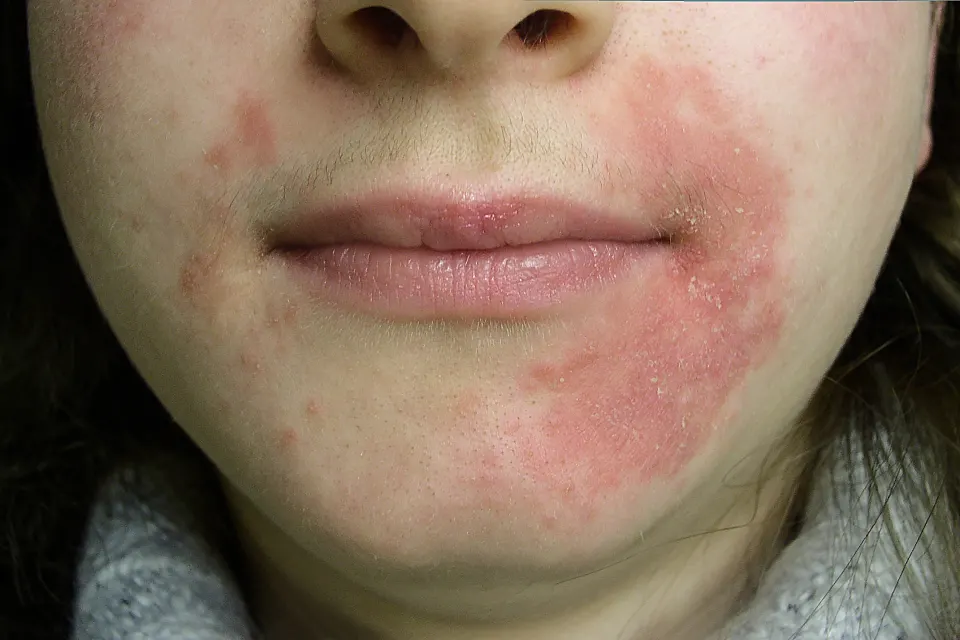 Periorale Dermatitis im Mundbereich
